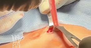 This is how you fix a stitch abscess