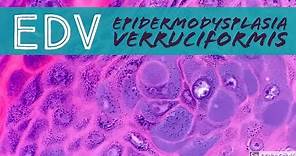 Epidermodysplasia verruciformis (EDV) 101
