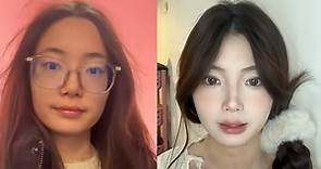 割雙眼皮｜頻貼眼皮貼致眼瞼變鬆　20歲女瞞父母偷割雙眼皮　「不想以後的事情」 - 香港經濟日報 - TOPick - 健康 - 保健美顏