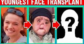 Plastic Surgeon Reacts to The Youngest Face Transplant! How'd She Do?