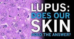 Lupus | Does our skin hold the answer?