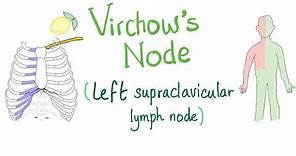 Virchow's Node (Left Supraclavicular Lymph Node)