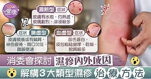 【對抗濕疹】消委會探討濕疹内外成因　解構3大類型濕疹治療方法 - 香港經濟日報 - TOPick - 健康 - 健康資訊