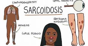 Understanding Sarcoidosis: A Visual Guide for Students