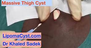 Massive Cyst Rupture. Dr Khaled Sadek. LipomaCyst.com