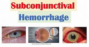 Subconjunctival Hemorrhage (Blood in Eye) | Causes, Signs & Symptoms, Diagnosis, Treatment