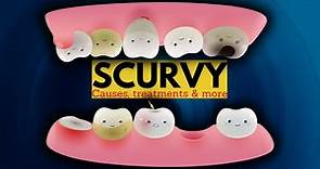 Scurvy : Symptoms, Causes, Treatment, And Prevention