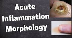 Acute Inflammation Morphology