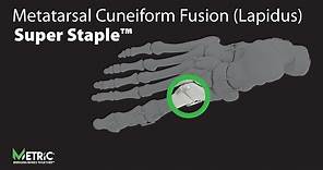Metatarsal Cuneiform Fusion (Lapidus) - Super Staple™