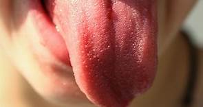 27歲女「舌頭反覆破洞」拖4年 竟罹患口腔癌手術切一半｜東森新聞
