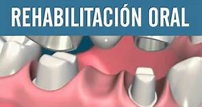 Rehabilitación Oral qué es? | Juan Salgado