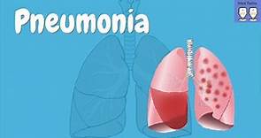 Pneumonia overview [Pathophysiology, Community vs Hospital acquired, Symptoms, CURB-65]