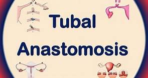Tubal Anastomosis | Tubal Ligation Reversal | Tubal Reversal Procedure