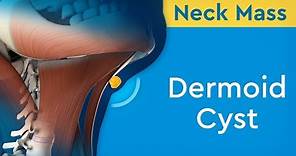 Neck Mass: Dermoid Cyst