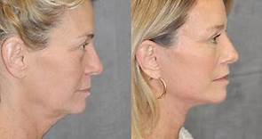 Beverly Hills Mini Lift Facelift & Lip Lift Local Anesthesia Wide Awake by Best Facelift Surgeon