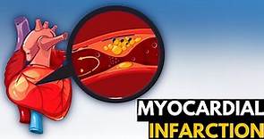 Myocardial Infarction, Causes, Signs and Symptoms, Diagnosis and Treatment.