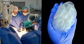 Doctores logran crear el primer corazón artificial