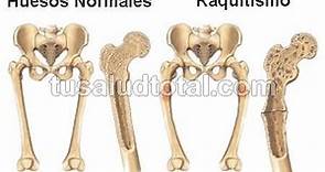 Qué es Raquitismo: Los 2 Tipos, Síntomas y Tratamiento