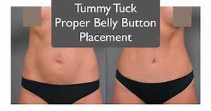 Belly Button Placement | Tummy Tuck Specialist Explains