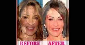 Patricia Heaton plastic surgery before and after photos