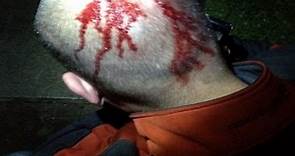 Zimmerman Injuries Seen in Exclusive Photo: Pictures from Night of Trayvon Martin's Death