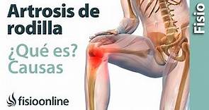 Artrosis o desgaste de rodilla - Qué es, causas, síntomas y tratamiento