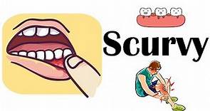 Scurvy (Vitamin C Deficiency) - Causes, Risk Factors, Signs & Symptoms, Diagnosis, And Treatment