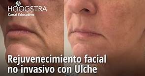 Rejuvenecimiento facial no invasivo con Ulche - 23279