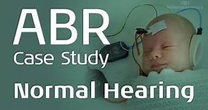 ABR Case Study: Normal Hearing