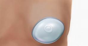Breast Implants | Breast Reconstruction Overview
