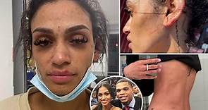 Wife of Hornets player Miles Bridges shares photos of alleged attack: ‘Can’t be silent anymore’