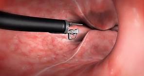 What Happens During the Endoscopic Sleeve Gastroplasty (ESG) Procedure?