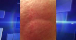 Skin Rash Leads to Shocking Diagnosis