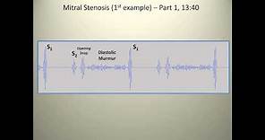 Examples of mitral stenosis murmurs
