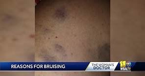 The Woman's Doctor: Different reasons for bruising on the skin