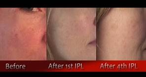 IPL Photofacial Review After 4 Treatments ~ Before & After