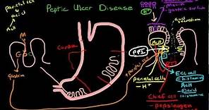 Peptic Ulcer Disease Pathophysiology