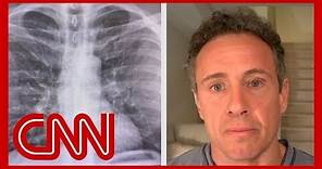 Chris Cuomo shares chest X-rays after coronavirus diagnosis