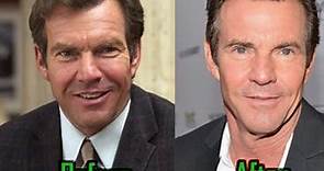 Dennis Quaid Before And After Plastic Surgery