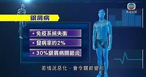 醫療：生物製劑治牛皮癬效果較顯著 副作用較少-20200321-TVB News