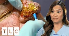 Dr. Lee Transforms Patient's Hugely Overgrown Nose I Dr. Pimple Popper: Pop Ups