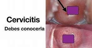 Cervicitis - Causas, síntomas, diagnóstico y tratamiento - ETS