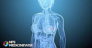 Breast tenderness and hormone replacement therapy (HRT) - from Tonic TV
