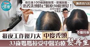 【改善脫髮】捱夜工作壓力大致中度禿頭　33歲媽媽接受中醫治療髮再生【附湯水食療】 - 香港經濟日報 - TOPick - 健康 - 醫生診症室
