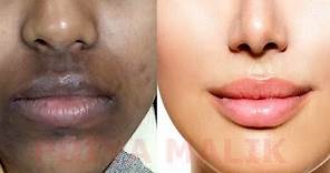 How To Remove Dark Black patches, Dark Spots,Hyper pigmentation, Around Your Mouth | PRIYA MALIK