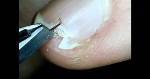 How to extract splinter from under fingernail
