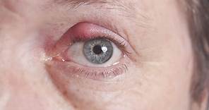 How to treat boils and styes