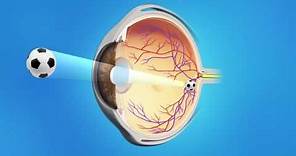 Cataract Surgery with a Toric Lens