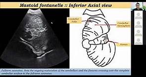 Part 6 :: Neonatal Cranial sonography:: Mastoid planes .. Posterior fossa :: Dr.Mohamed Soliman