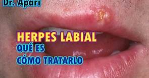 COMO ELIMINAR EL HERPES LABIAL - DR. APARI